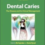 Dental Caries: The Disease and its Clinical Management (Color)