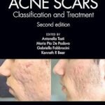 Acne Scars: Classification and Treatment (Color)