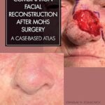 Combination Facial Reconstruction after Mohs Surgery: A Case Based Atlas (Color)