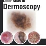 Color Atlas of Dermoscopy (Color)