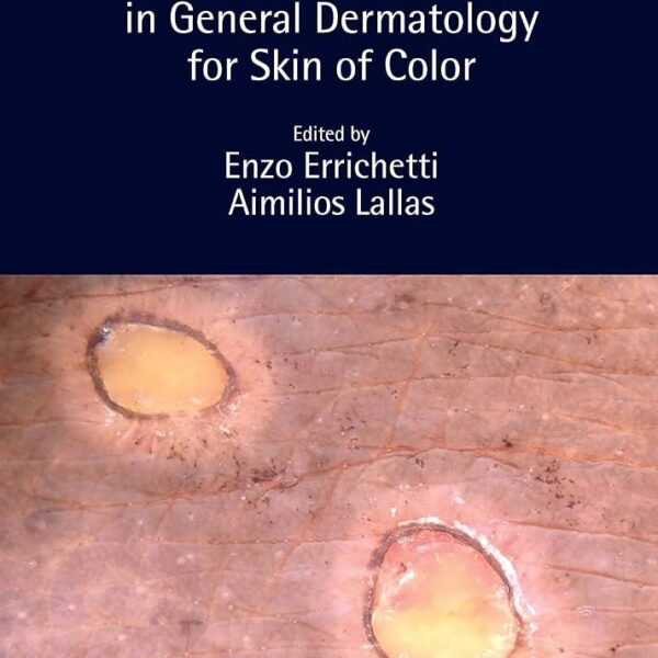 Dermoscopy in General Dermatology for Skin of Color (Color)
