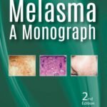 Melasma :A Monograph (Color)
