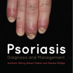 Psoriasis Diagnosis and Management (Color)