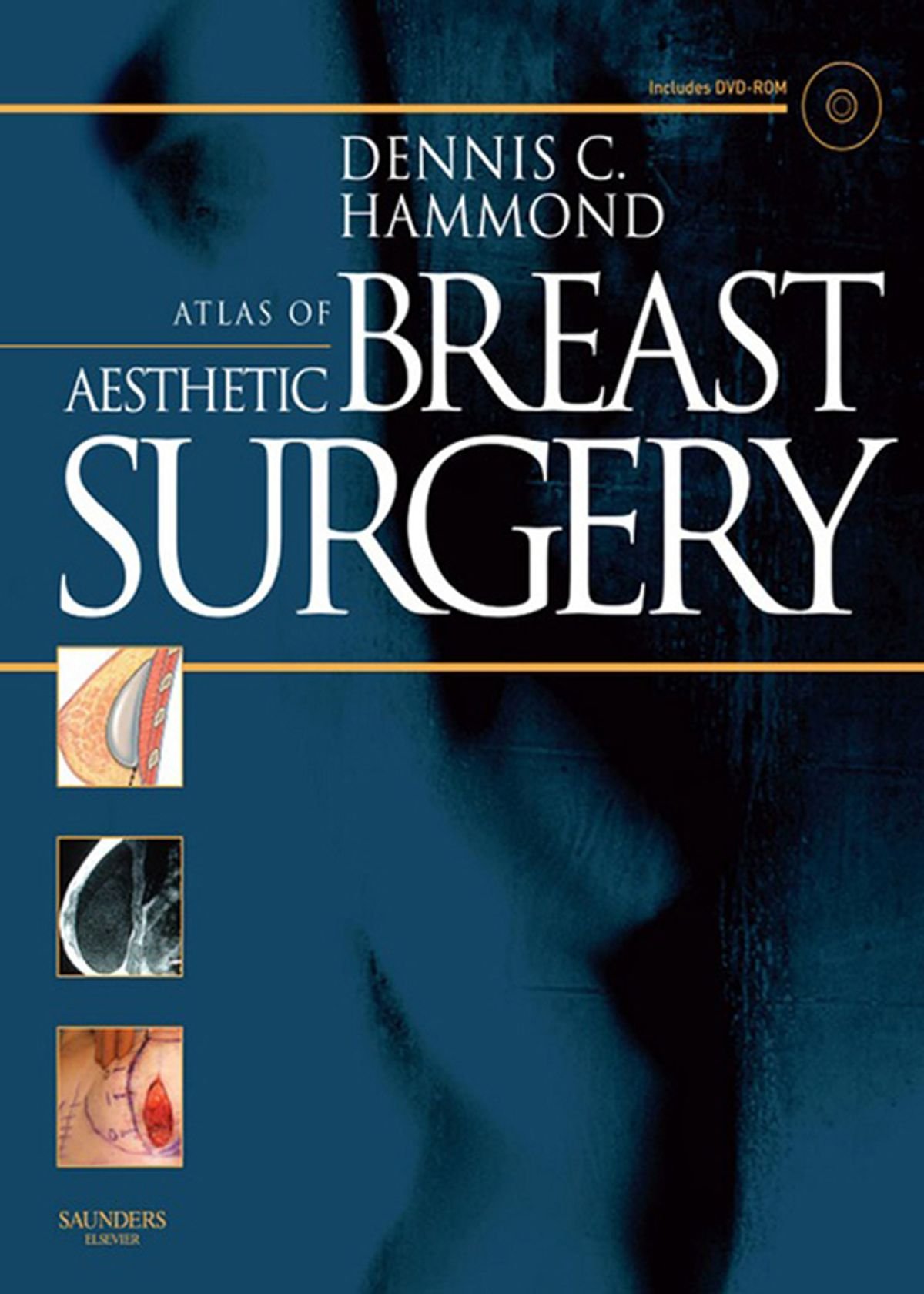 atlas-of-aesthetic-breast-surgery Atlas of Aesthetic Breast Surgery (Color) - Image 1